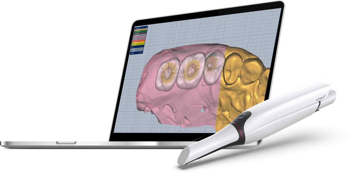 구강스캐너를 이용한 디지털 진료