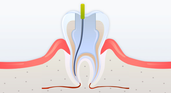 충치 및 신경조직 제거